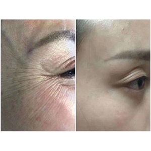 西安激光除皱医院哪家好？画美、英蓓仪、侨美等医院技术实力解析