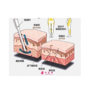 长沙雅美医疗美容医院自体脂肪填充：面部年轻化的自然选择