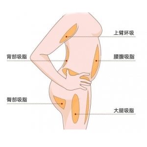淮安市第一人民医院去副乳手术价格贵吗？专业医生团队在线解答