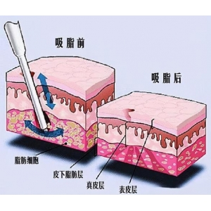 无锡苏亚医疗美容医院吸脂去副乳技术怎么样？哪位医生技术更专业？