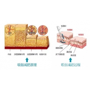 江苏施尔美整形自体脂肪隆鼻怎么样？南京鼻整形医生深度解析