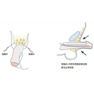 合肥去副乳医生排名：哪些医生术后效果更自然？