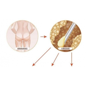 北京东方和谐王自谦怎么样？做大腿吸脂真实效果如何
