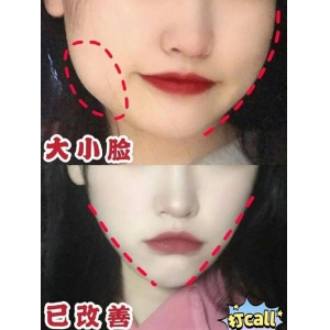 方叶琴做颧骨颧弓怎么样？杭州维多利亚医疗美容医院真实案例分享