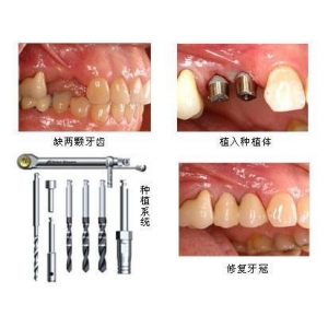 韩国沃兰种植牙技术怎么样？探讨其优缺点及性价比，是否值得选择？