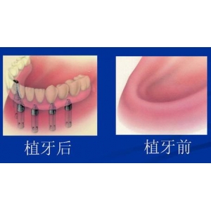 韩国登腾与瑞士ITI种植牙比较：哪个更好？多收一万是否合理？技术差异解析