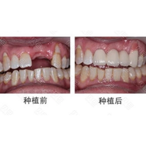 郑州美莱医疗美容医院做牙齿种植靠谱吗？种植牙医生团队+价格解析
