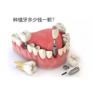 衡阳德贝口腔种植牙价格表：韩国种植牙2026元起，瑞士种植牙2026元起，价格表解析