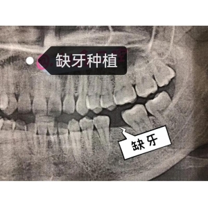 韩国登腾种植牙价格对比：一代与二代费用差异及优势一览表