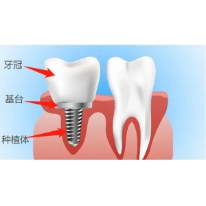 呼和浩特至美口腔金港湾门诊部怎么样？十五年老牌牙科+数字化种植技术+医生团队经验丰富！