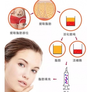 哈尔滨伊美尔自体脂肪填充价格贵吗？医生团队与术后护理全解析