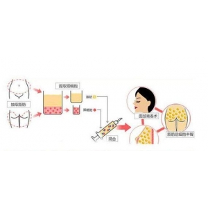 昆明做自体脂肪丰卧蚕哪家医院好？5家实力机构深度解析