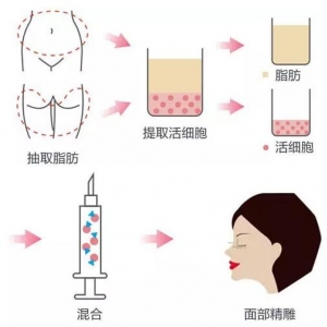 深圳南西子医疗美容门诊部自体脂肪丰鼻基底多少钱？最新价格表一览！