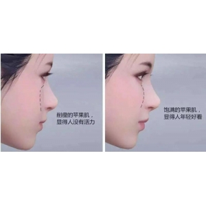 徐州华美美容医院做自体脂肪填充靠谱吗？真实案例与医生技术全解析