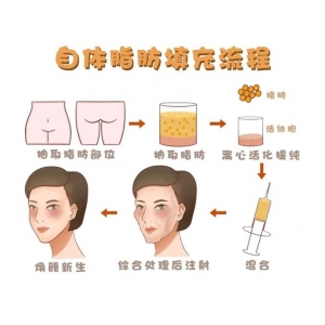 南昌佳美美容医院自体脂肪祛泪沟价格多少？专家团队详细介绍