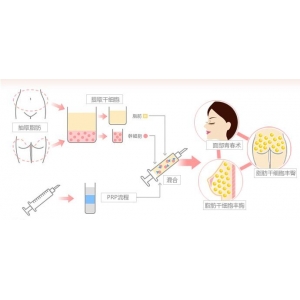 昆明华美美莱美容医院自体脂肪丰鼻基底多少钱？知名医生团队及价格表汇总